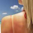 Here's How To Stop An Itchy Sunburn Fast