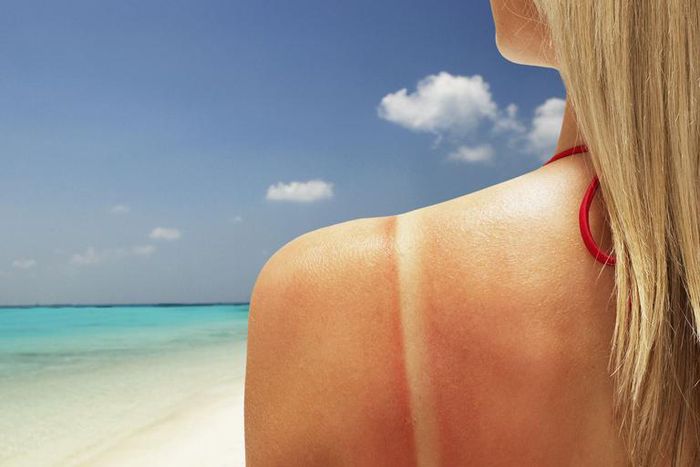 Here's How To Stop An Itchy Sunburn Fast