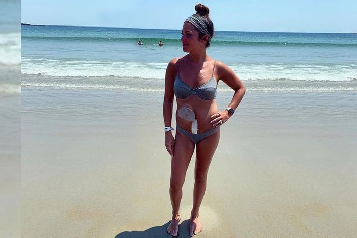 What It's Like To Be A 30-Year-Old Without A Colon