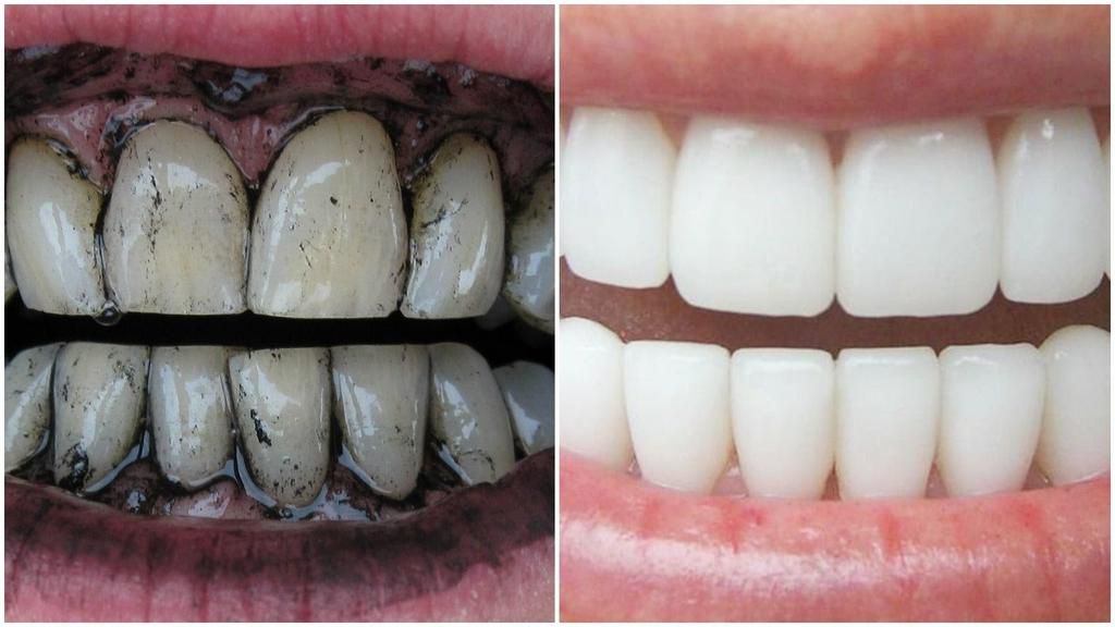 whiten the teeth with charcoal