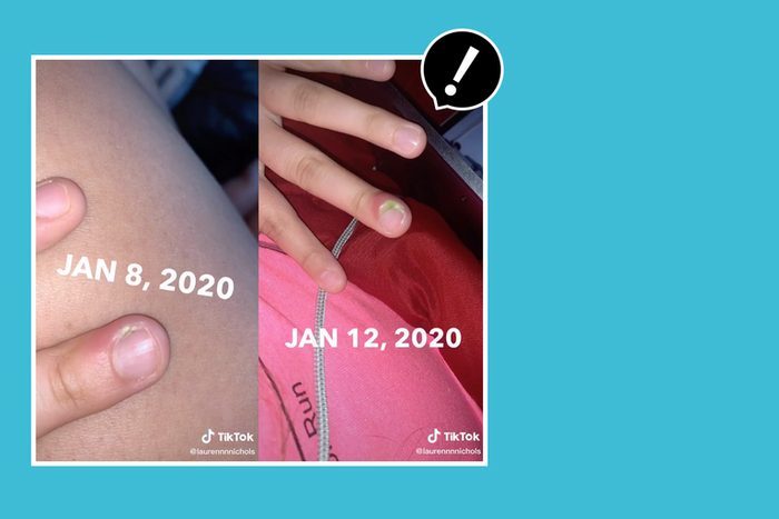 Teen Warns Against Nail Biting After Infection