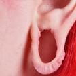 Dr. Pimple Popper Repairs a Stretched Earlobe