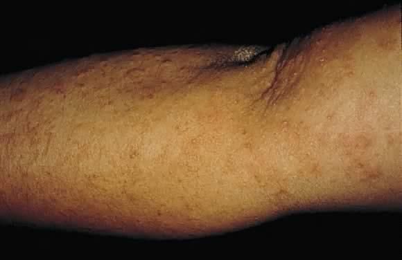 Here are rashes that could occur during pregnancy second trimester