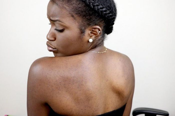 back acne