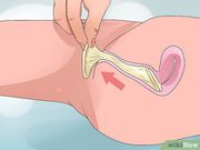What to do if a condom gets stuck in your vagina