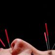 Can Acupuncture Really Help You Lose Weight?