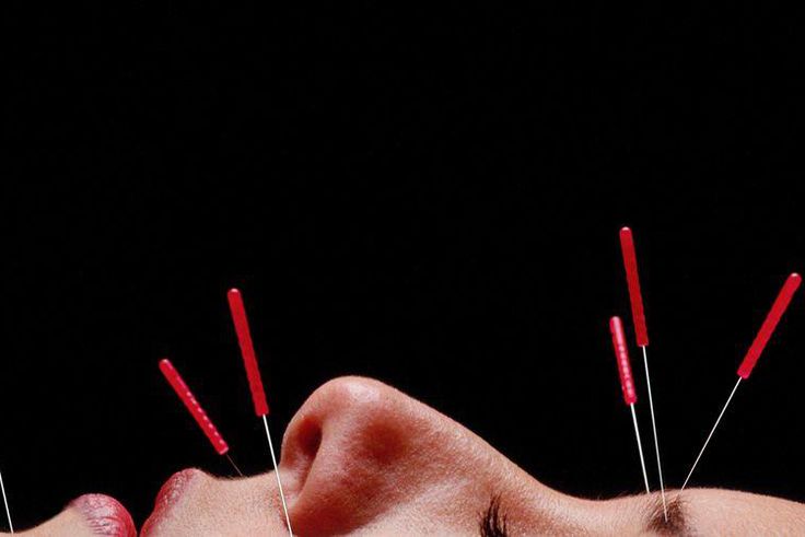Can Acupuncture Really Help You Lose Weight?