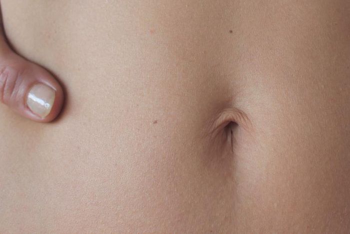 Dr. P Just Popped A 'Belly Button' Cyst