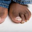 4 home remedies to treating toenail fungus