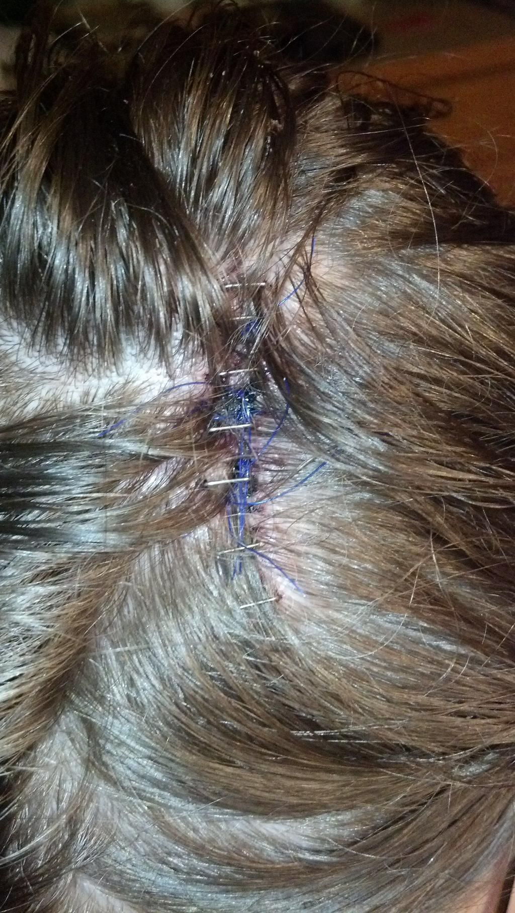 A close up of Alys scalp post-surgery
