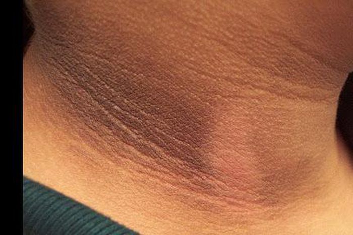 Skin hyperpigmentation in pregnancy: Causes, prevention, remedies