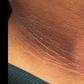 Skin hyperpigmentation in pregnancy: Causes, prevention, remedies