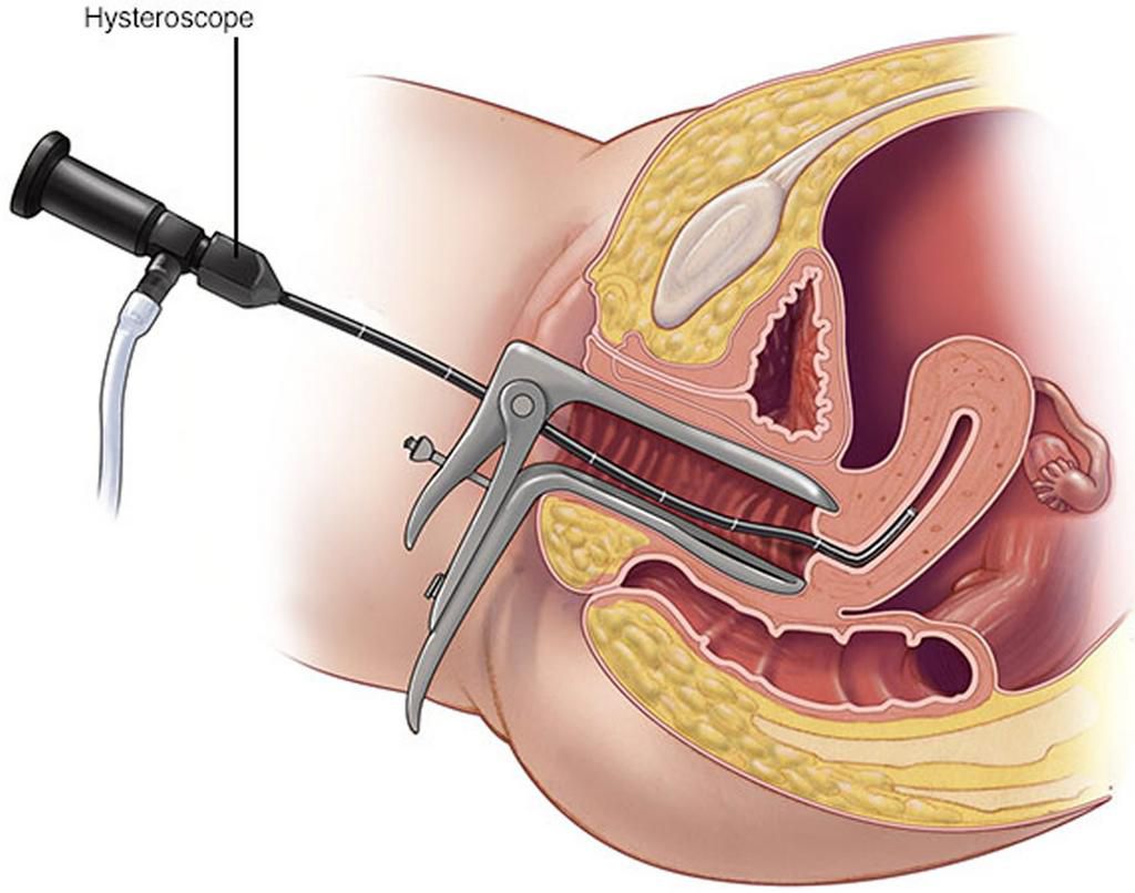 Pregnancy after Dilation and Curettage (D&C): Is it possible?