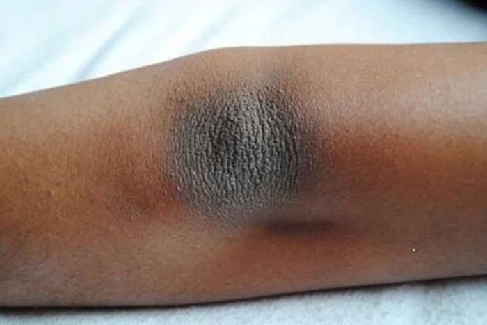 4 home remedies to get rid of dark knees and elbows