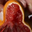 Watch Dr. P Extract The Juiciest Blackheads
