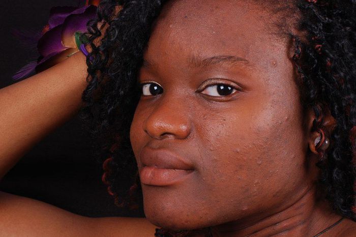 5 natural ways to get rid of acne scars and pimple marks