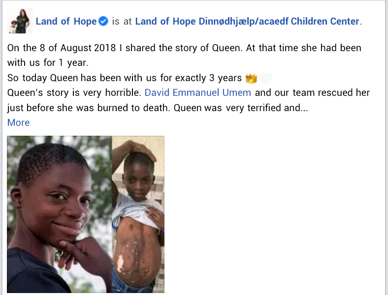 3-year-old girl accused of witchcraft and set ablaze has transformed