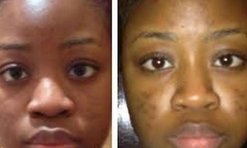 14 home remedies that cure pimples fast