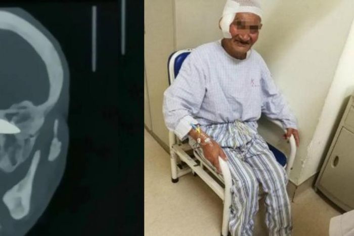 Doctors remove 4-inch-long rusty knife from man’s head 26 years after he was stabbed (photos)