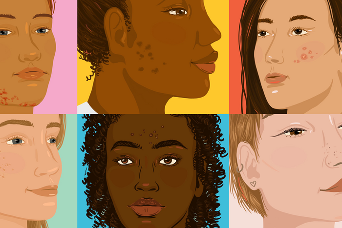 How to Cover Up Every Type of Acne