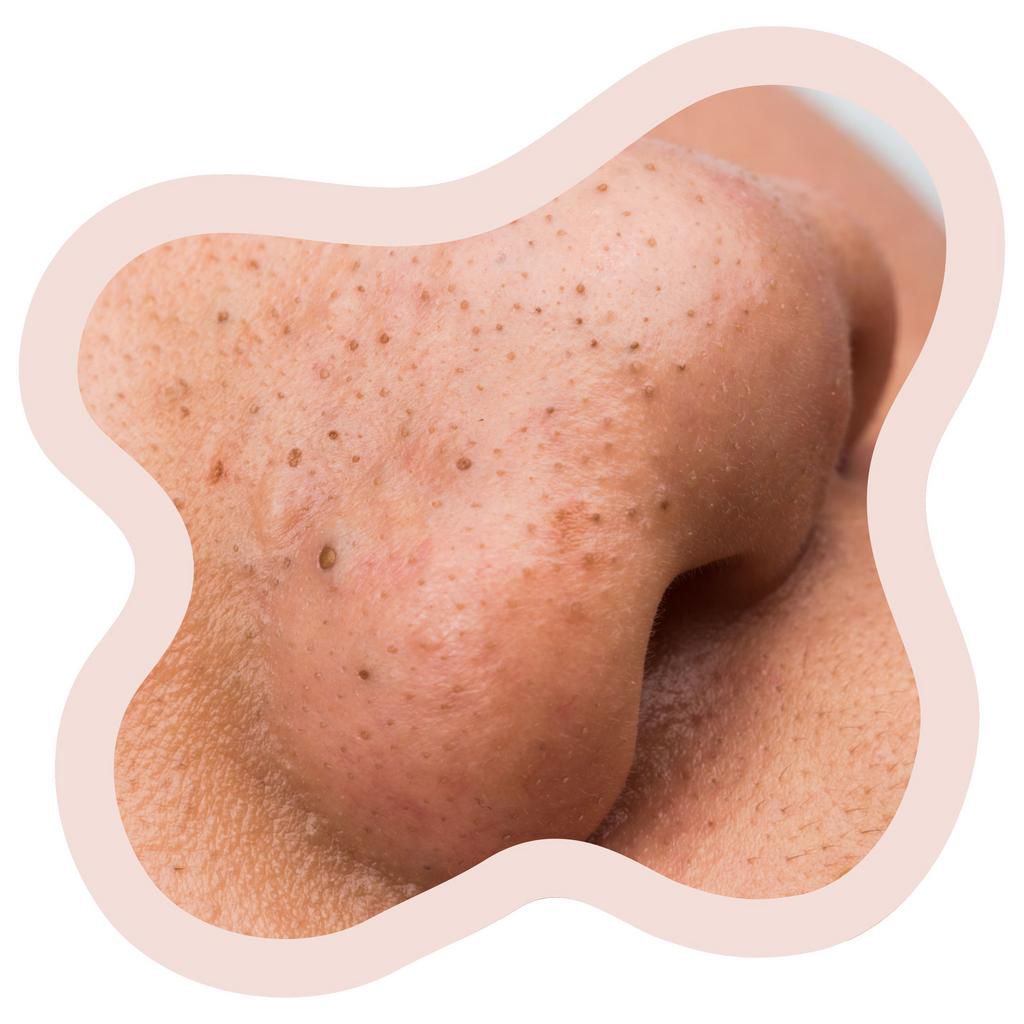 Blackhead acne