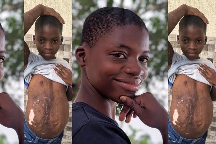 3-year-old girl accused of witchcraft and set ablaze has transformed