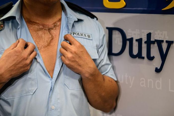 Hong Kong policeman, who asked to be identified as Ling, was struck by corrosive liquid on October 1 when unrest swept through the city on China's National Day.