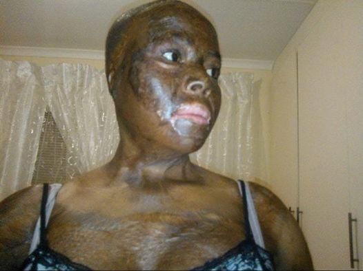 Woman recalls how she lost her daughter after lover set them ablaze