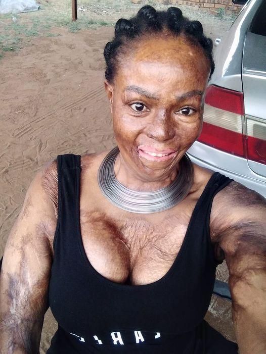 Woman recalls how she lost her daughter after lover set them ablaze