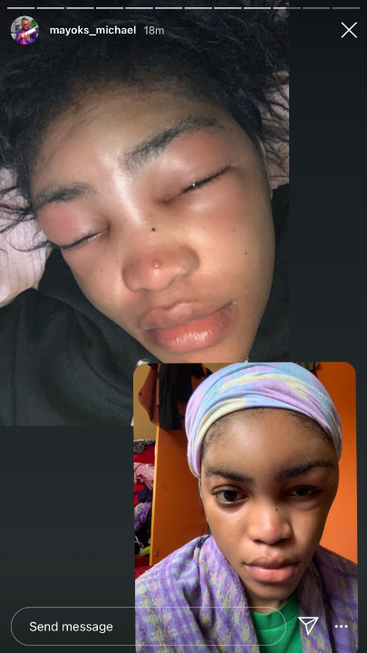 Photos of Camille's badly bruised face [KemiFilani]