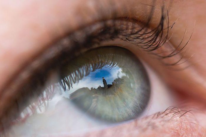 Dr. Pimple Popper Pops a Blackhead Next to an Eye