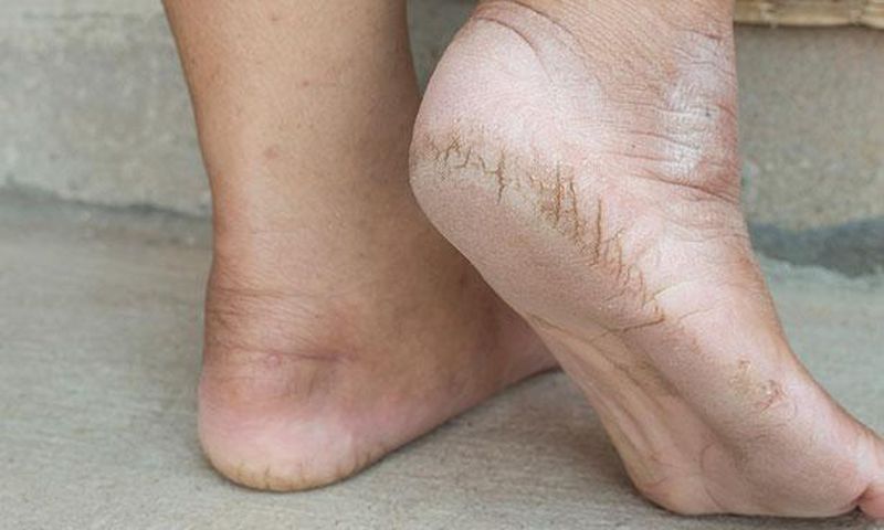 Cracked heels