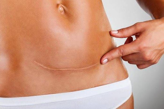 Your complete guide to C-section recovery