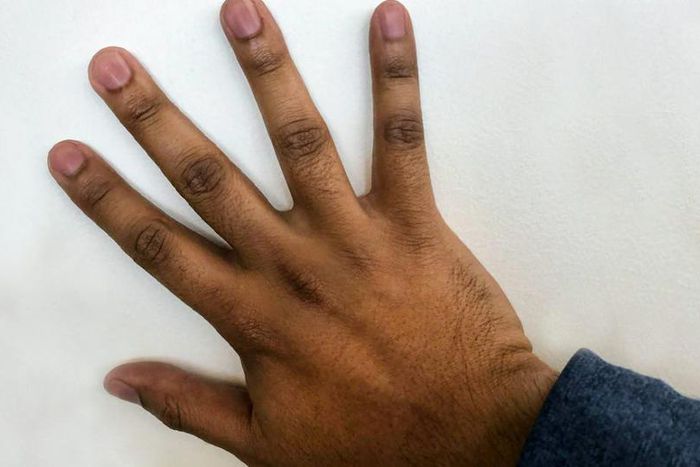 Dark Knuckles can make a person feel self conscious [healthline]