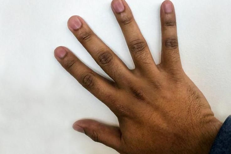 Dark Knuckles can make a person feel self conscious [healthline]