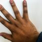 Dark Knuckles can make a person feel self conscious [healthline]