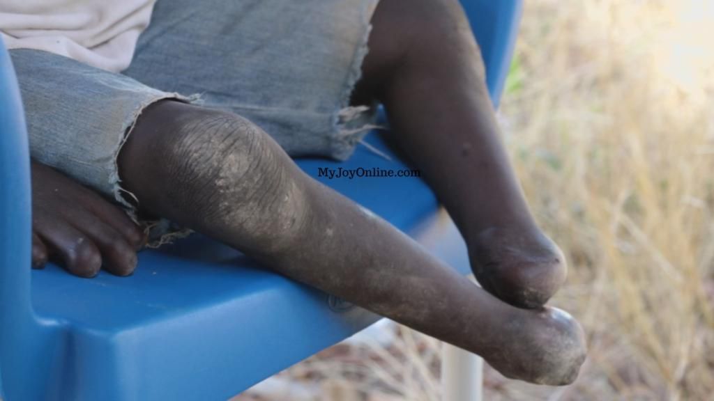 Mother calls for help to enable son who has lost his feet to walk again