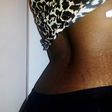 5 home remedies to treat stretch marks