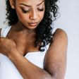 Eczema can be extremely disturbing {african belle}