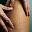 Stretch marks