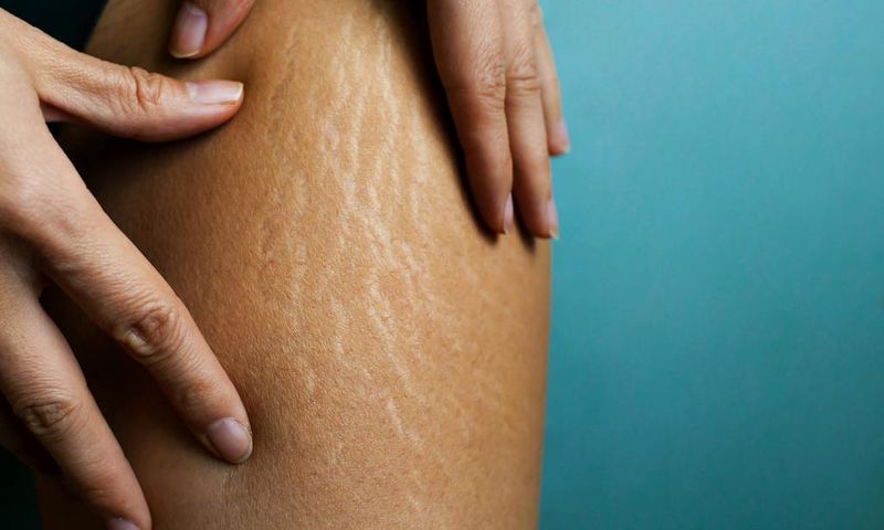 Stretch marks