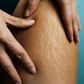 Stretch marks
