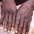 Cutar monkeypox