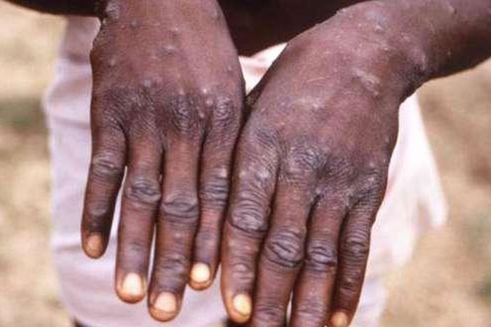 Cutar monkeypox