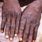 Cutar monkeypox