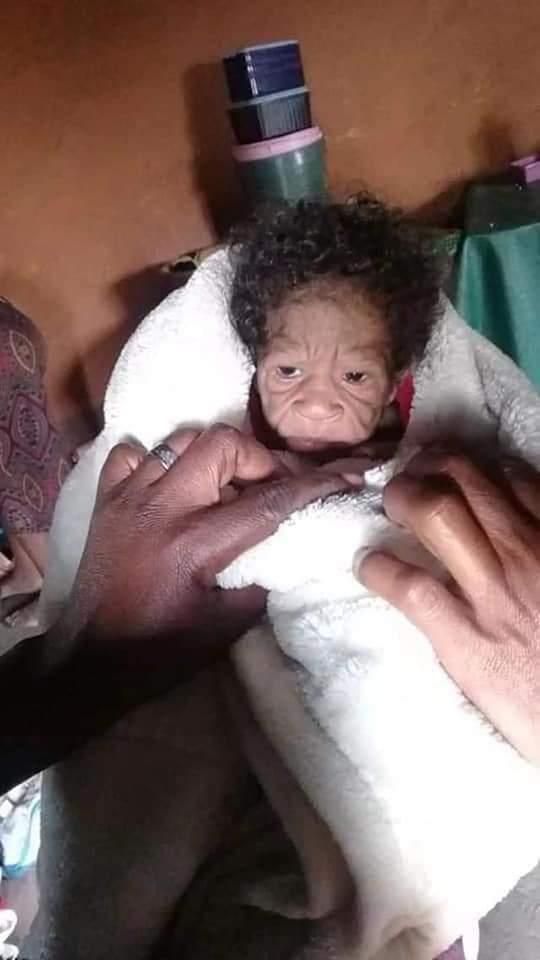 Rare condition makes 2-month-old baby girl look old with wrinkled face