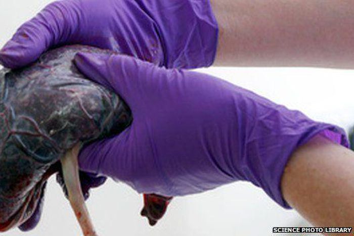 Stop eating placenta after childbirth, experts warn new mothers. [bbc]