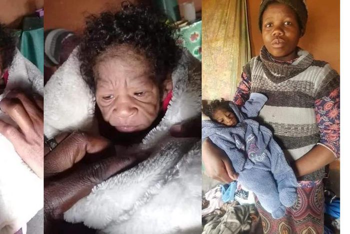 Rare condition makes 2-month-old baby girl look old with wrinkled face