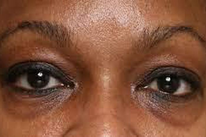 Dark eye circles are definitely not a good look [naturalandbrown]