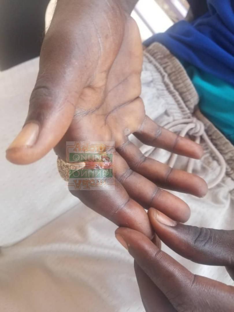 Pantang teenager's index finger rots away after wearing stolen ‘spiritual’ ring
